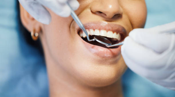 Best Emergency Dentist for Lost Fillings or Crowns in Lexington, IL